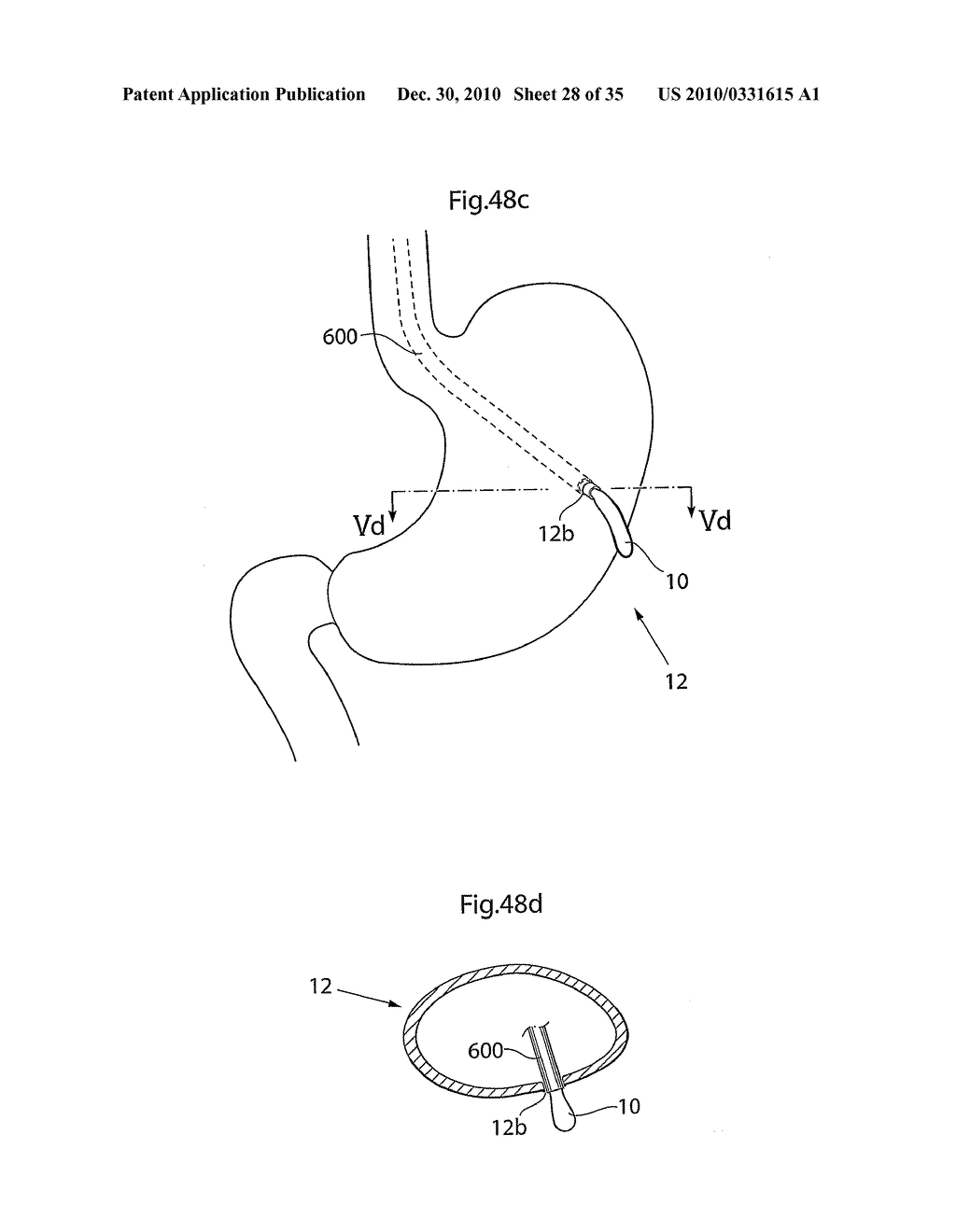 METHOD AND INSTRUMENTS FOR TREATING GERD - diagram, schematic, and image 29