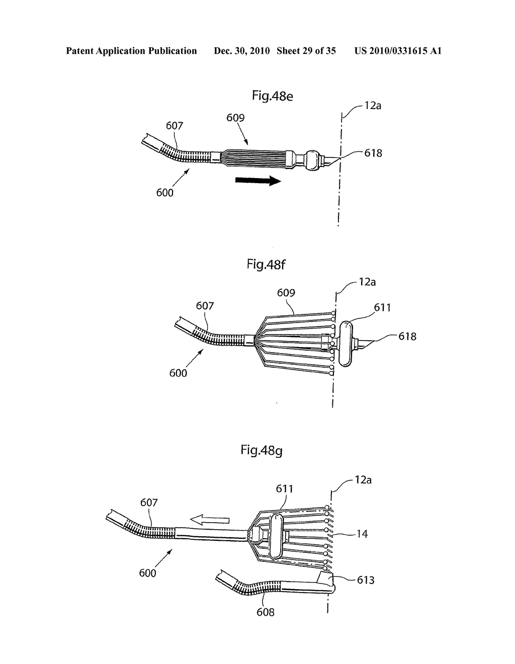 METHOD AND INSTRUMENTS FOR TREATING GERD - diagram, schematic, and image 30