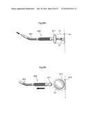 METHOD AND INSTRUMENTS FOR TREATING GERD diagram and image