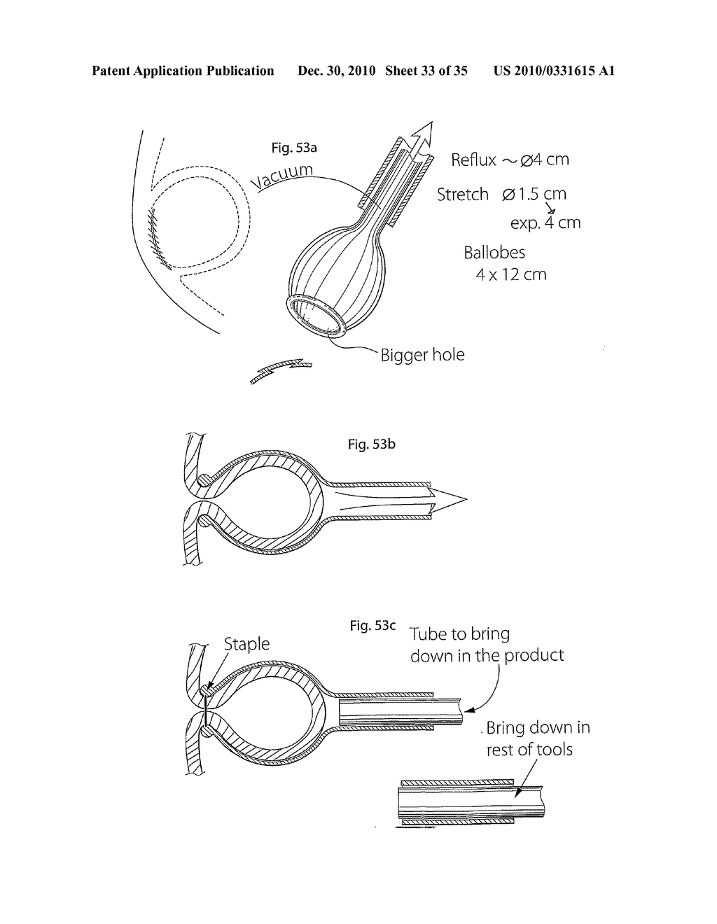 METHOD AND INSTRUMENTS FOR TREATING GERD - diagram, schematic, and image 34