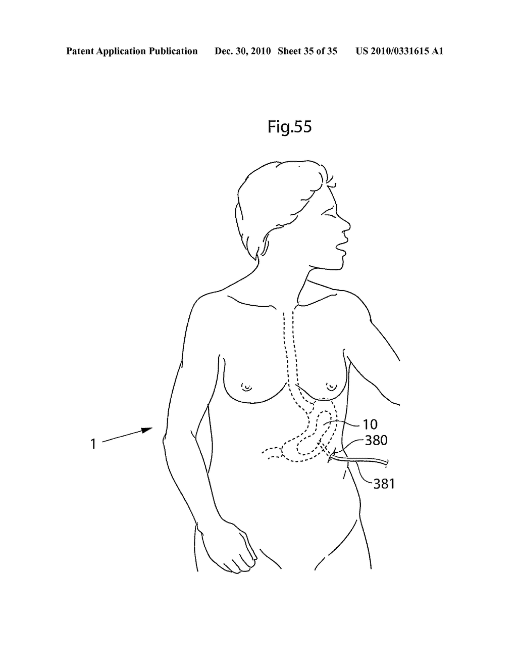 METHOD AND INSTRUMENTS FOR TREATING GERD - diagram, schematic, and image 36