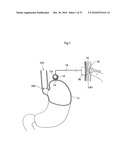 METHOD AND INSTRUMENT FOR TREATING OBESITY diagram and image