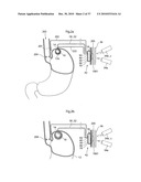 METHOD AND INSTRUMENT FOR TREATING OBESITY diagram and image