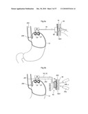 METHOD AND INSTRUMENT FOR TREATING OBESITY diagram and image