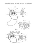 METHOD AND INSTRUMENT FOR TREATING OBESITY diagram and image