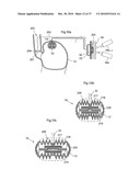 METHOD AND INSTRUMENT FOR TREATING OBESITY diagram and image