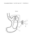 METHOD AND INSTRUMENT FOR TREATING OBESITY diagram and image