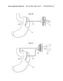 METHOD AND INSTRUMENT FOR TREATING OBESITY diagram and image