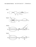 METHOD AND INSTRUMENT FOR TREATING OBESITY diagram and image