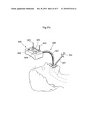 METHOD AND INSTRUMENT FOR TREATING OBESITY diagram and image