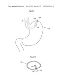 METHOD AND INSTRUMENT FOR TREATING OBESITY diagram and image