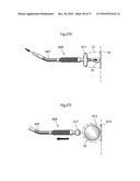 METHOD AND INSTRUMENT FOR TREATING OBESITY diagram and image