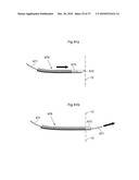 METHOD AND INSTRUMENT FOR TREATING OBESITY diagram and image