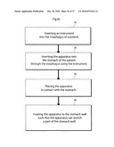 METHOD AND INSTRUMENT FOR TREATING OBESITY diagram and image