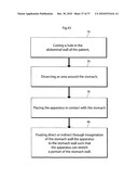 METHOD AND INSTRUMENT FOR TREATING OBESITY diagram and image