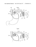 DEVICE, SYSTEM AND METHOD FOR TREATING OBESITY diagram and image