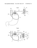 DEVICE, SYSTEM AND METHOD FOR TREATING OBESITY diagram and image