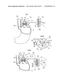 DEVICE, SYSTEM AND METHOD FOR TREATING OBESITY diagram and image