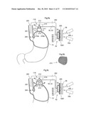 DEVICE, SYSTEM AND METHOD FOR TREATING OBESITY diagram and image