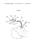 DEVICE, SYSTEM AND METHOD FOR TREATING OBESITY diagram and image