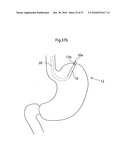 DEVICE, SYSTEM AND METHOD FOR TREATING OBESITY diagram and image