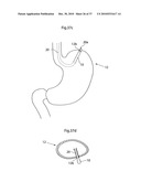 DEVICE, SYSTEM AND METHOD FOR TREATING OBESITY diagram and image