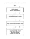 DEVICE, SYSTEM AND METHOD FOR TREATING OBESITY diagram and image