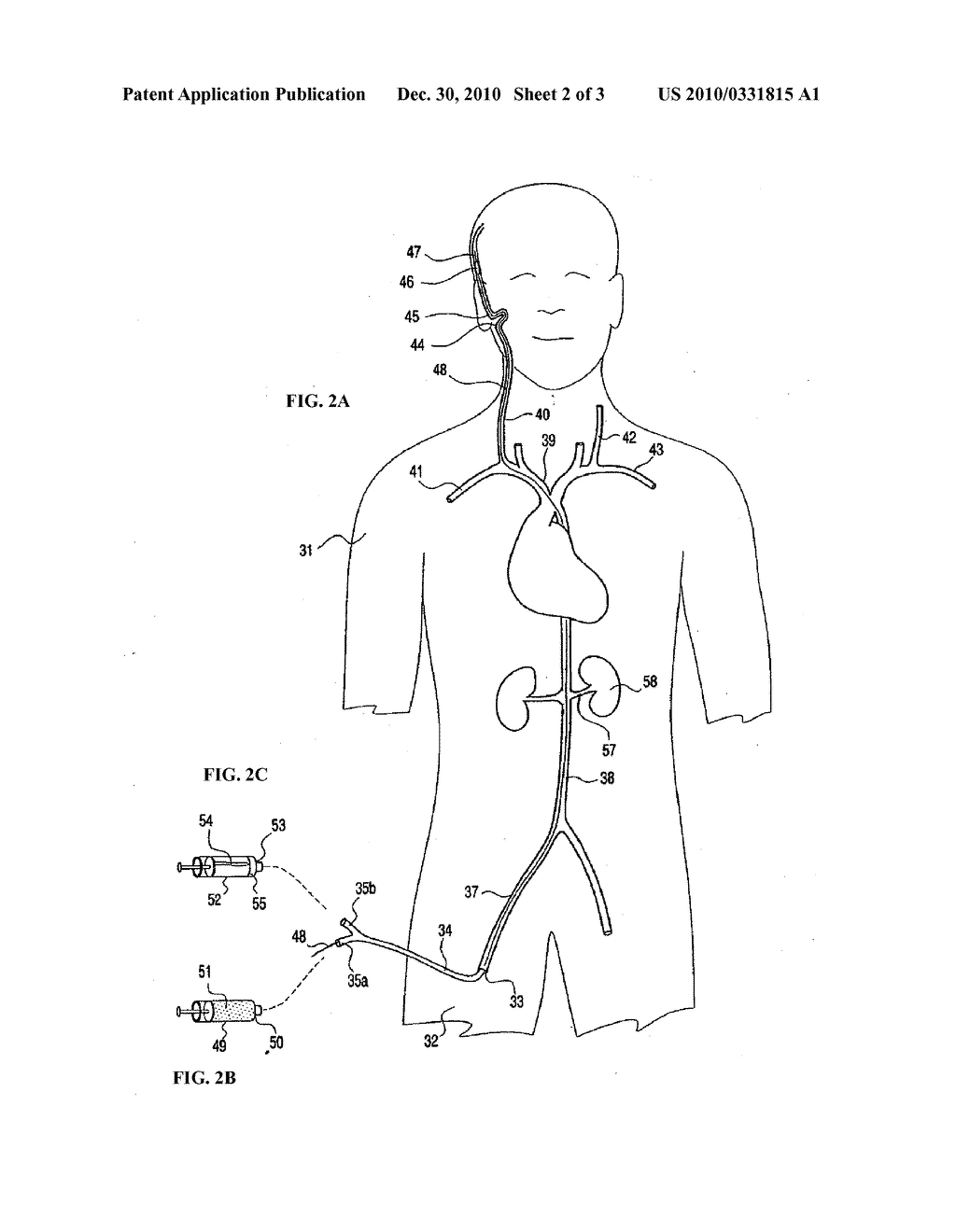 TRANSLUMINAL DELIVERY OF ONCOLTYIC VIRUSES FOR CANCER THERAPY - diagram, schematic, and image 03