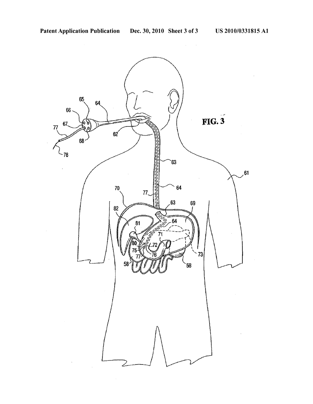 TRANSLUMINAL DELIVERY OF ONCOLTYIC VIRUSES FOR CANCER THERAPY - diagram, schematic, and image 04