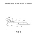 Bone fracture treatment devices and methods of their use diagram and image