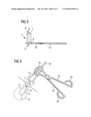 METHOD AND DEVICE FOR REMOVING A BALLOON FROM A BODY CAVITY diagram and image