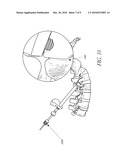 SYSTEM AND METHOD FOR SPINAL FIXATION diagram and image