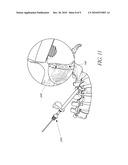 SYSTEM AND METHOD FOR SPINAL FIXATION diagram and image