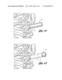 BONE REPAIR SYSTEM AND METHOD diagram and image