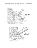 BONE REPAIR SYSTEM AND METHOD diagram and image