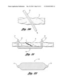 BONE REPAIR SYSTEM AND METHOD diagram and image