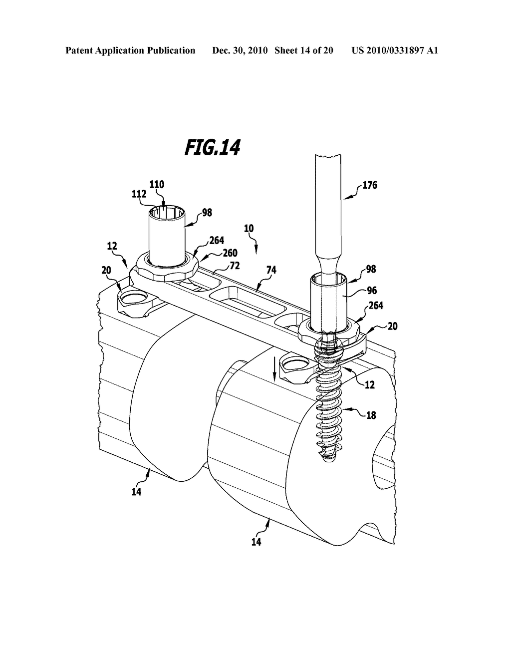 SURGICAL BONE ANCHORING DEVICE AND SPINAL COLUMN FIXATION SYSTEM - diagram, schematic, and image 15