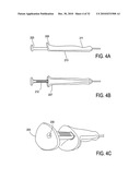 SURGICAL TOOLS FOR TREATMENT OF SPINAL STENOSIS diagram and image