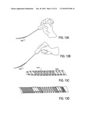 SURGICAL TOOLS FOR TREATMENT OF SPINAL STENOSIS diagram and image