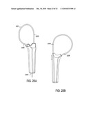 SURGICAL TOOLS FOR TREATMENT OF SPINAL STENOSIS diagram and image