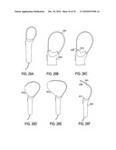 SURGICAL TOOLS FOR TREATMENT OF SPINAL STENOSIS diagram and image