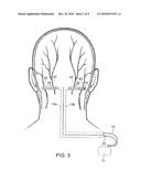 SYSTEM AND METHOD FOR COMPENSATING FOR SHIFTING OF NEUROSTIMULATION LEADS IN A PATIENT diagram and image