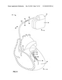 IMPLANTABLE MEDICAL DEVICE LEAD diagram and image