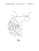 EXTENDABLE/RETRACTABLE LEAD WITH IMPROVED DISTAL SEAL diagram and image