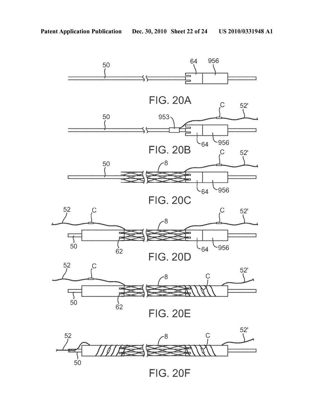 IMPLANT DELIVERY APPARATUS AND METHODS WITH ELECTROLYTIC RELEASE - diagram, schematic, and image 23