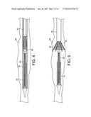 STENTS, DEVICES FOR USE WITH STENTS AND METHODS RELATING THERETO diagram and image