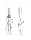 STENTS, DEVICES FOR USE WITH STENTS AND METHODS RELATING THERETO diagram and image