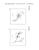 SYSTEM AND METHOD FOR DELIVERING A STENT TO A SELECTED POSITION WITHIN A LUMEN diagram and image