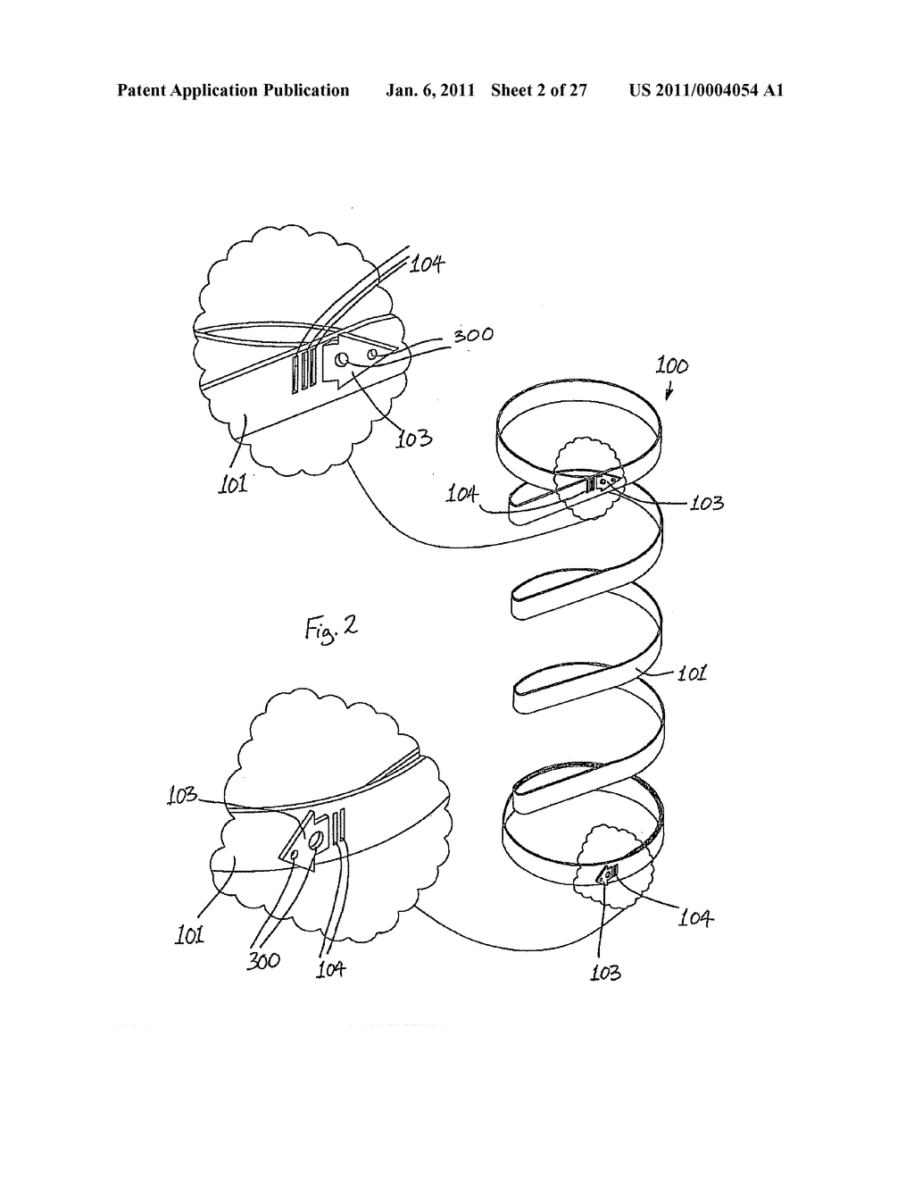 Gastric Constriction Device - diagram, schematic, and image 03