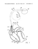 ISCHEMIA DETECTION USING INTRA-CARDIAC SIGNALS diagram and image